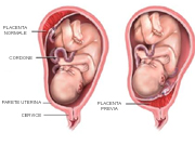Placenta_previa